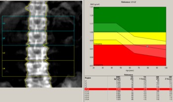 What is the conduct of densitometry.